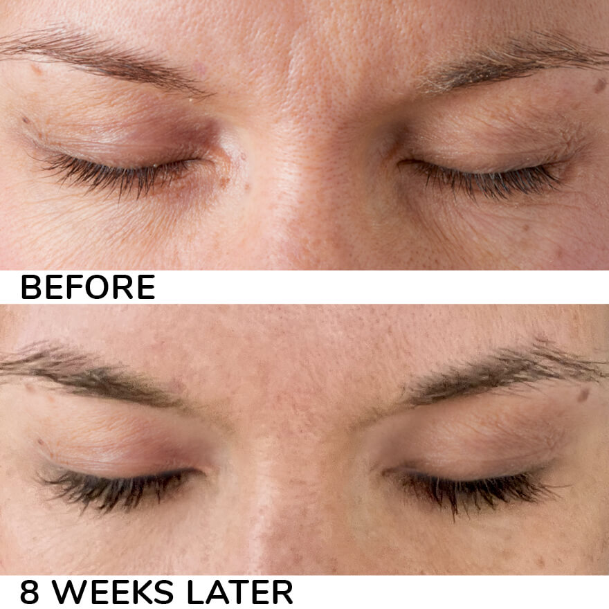 Generic Latisse Eyelash Serum Before and After